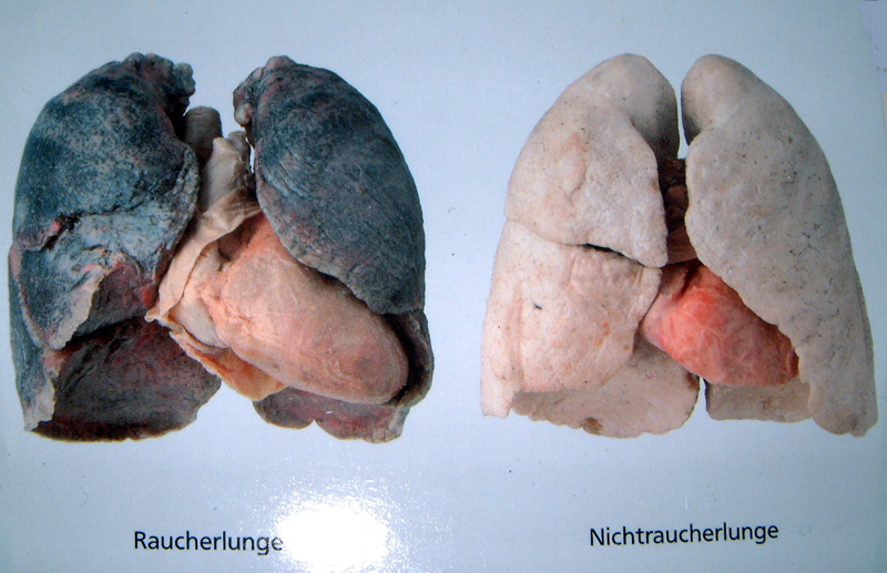Raucherlunge.jpg